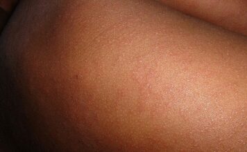 Jak odróżnić wysypkę alergiczną od wysypki przy chorobie zakaźnej wysypka